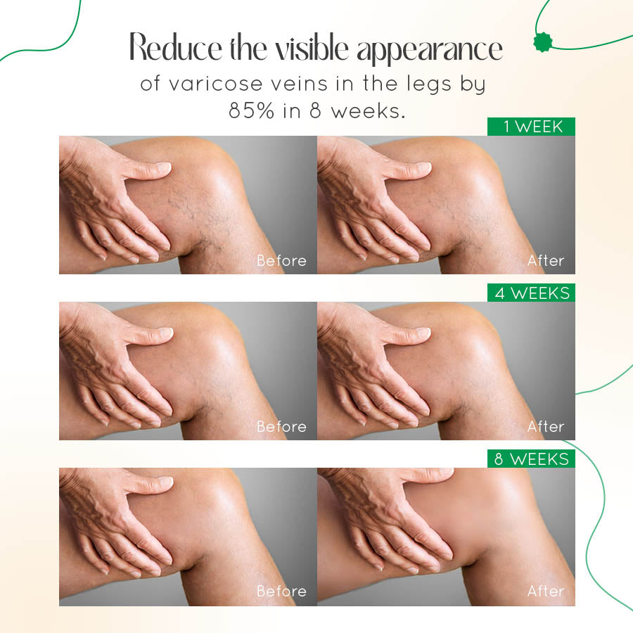 Seurico™ Varicose Vein Relief Cream🌿
